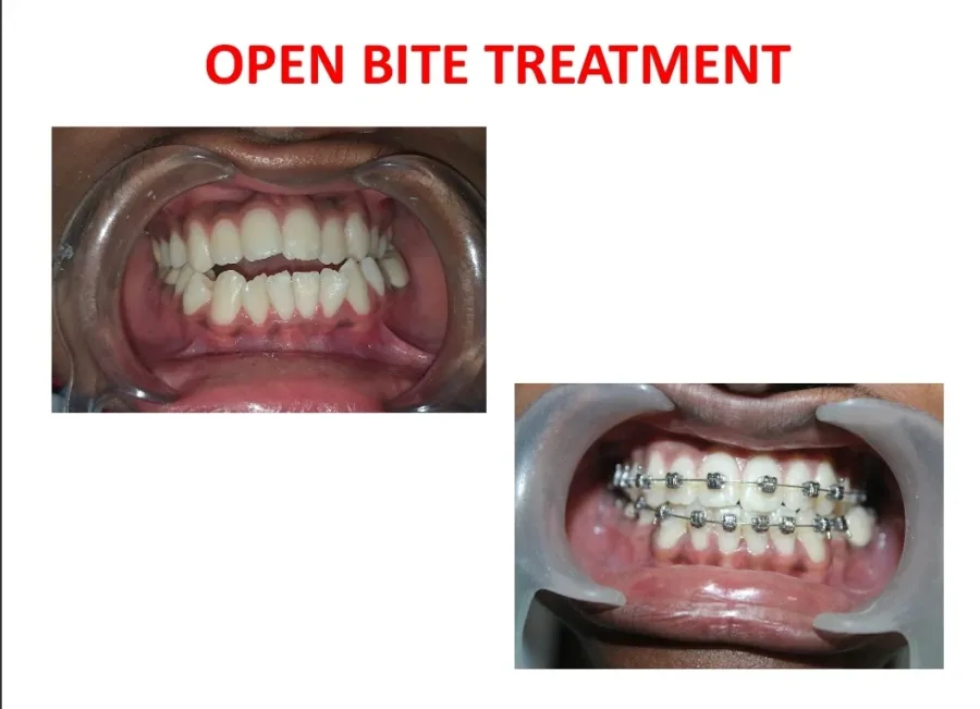Before and after — open bite corrected with orthodontic treatment at Arasu Dental Care, Coimbatore