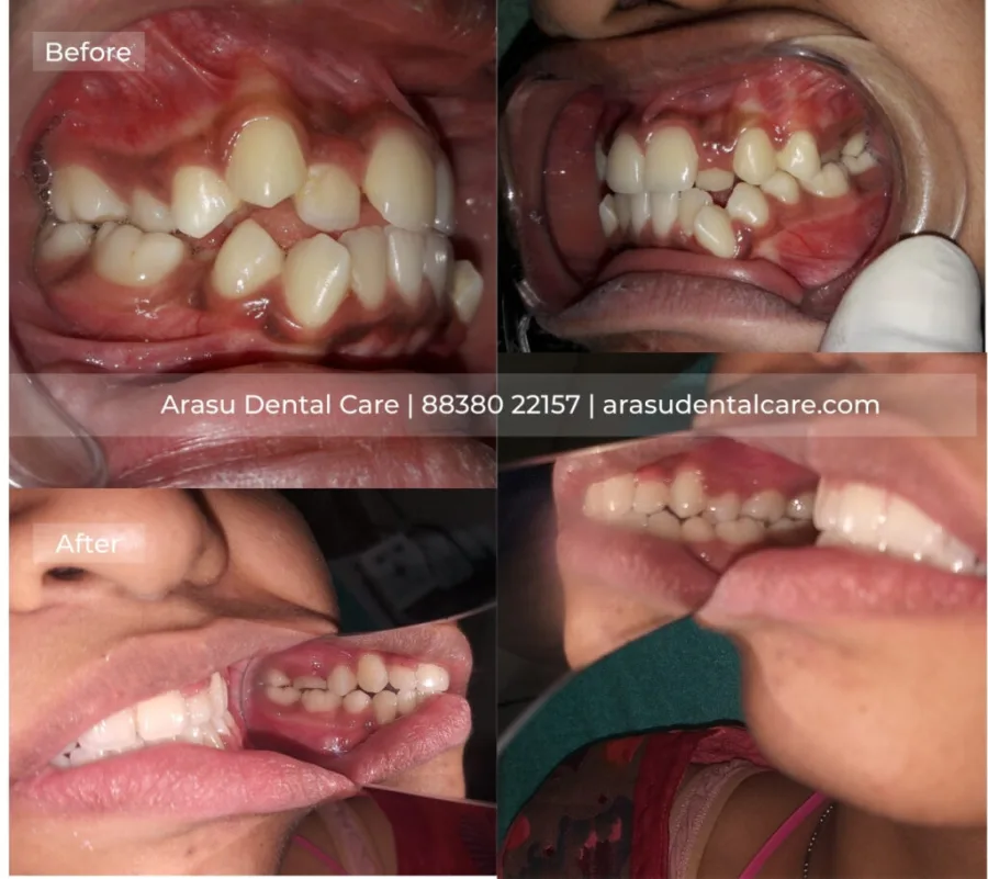 Before and after — protruding front teeth corrected with orthodontic treatment at Arasu Dental Care, R.S. Puram, Coimbatore