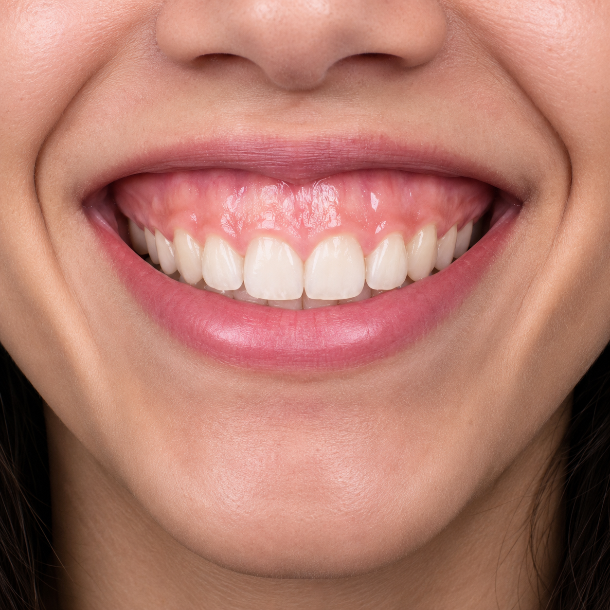 Gummy smile - Arasu Dental Care, Coimbatore