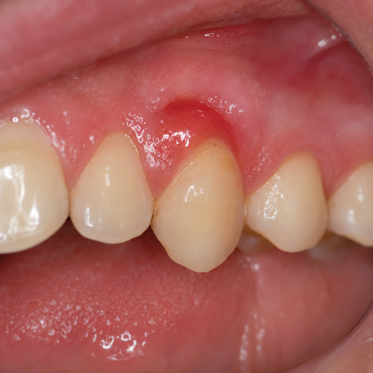 Swelling or redness tooth - Arasu Dental Care, Coimbatore