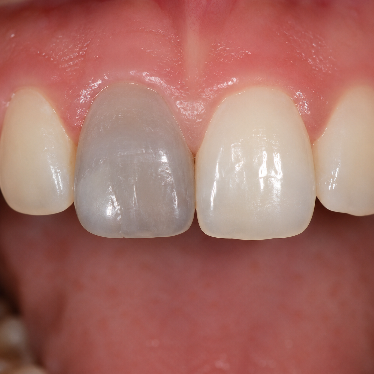 Tooth turning dark or grey - Arasu Dental Care, Coimbatore