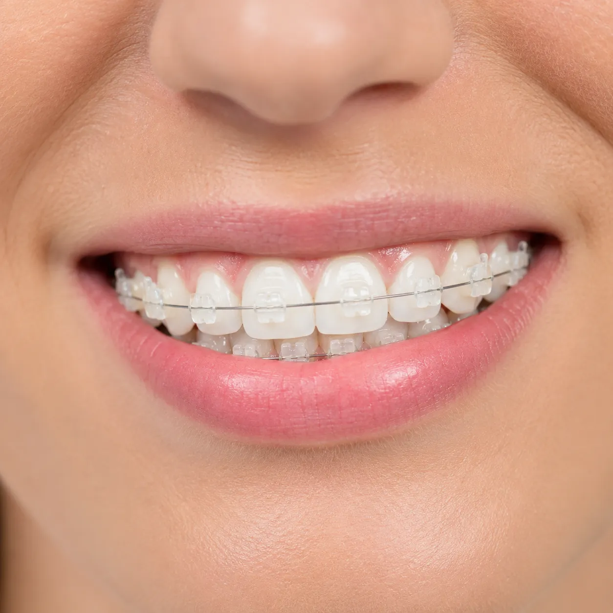 Smile with tooth-coloured ceramic braces - Arasu Dental Care, Coimbatore