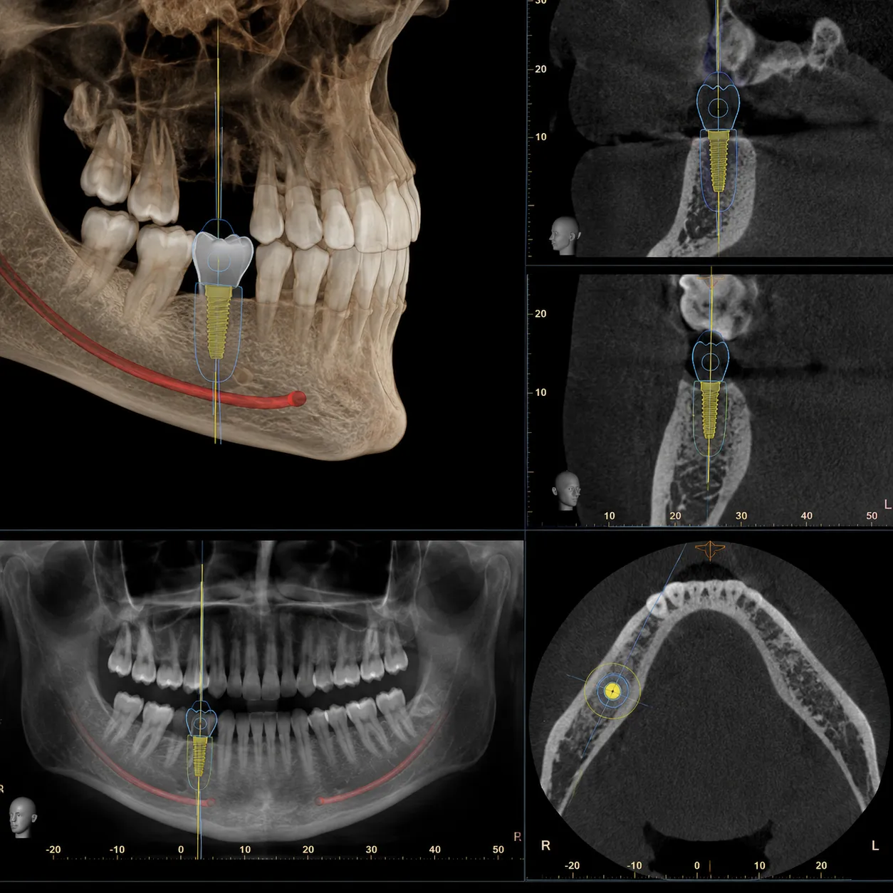 CBCT planning view mapping the implant position on the jaw - Arasu Dental Care, Coimbatore