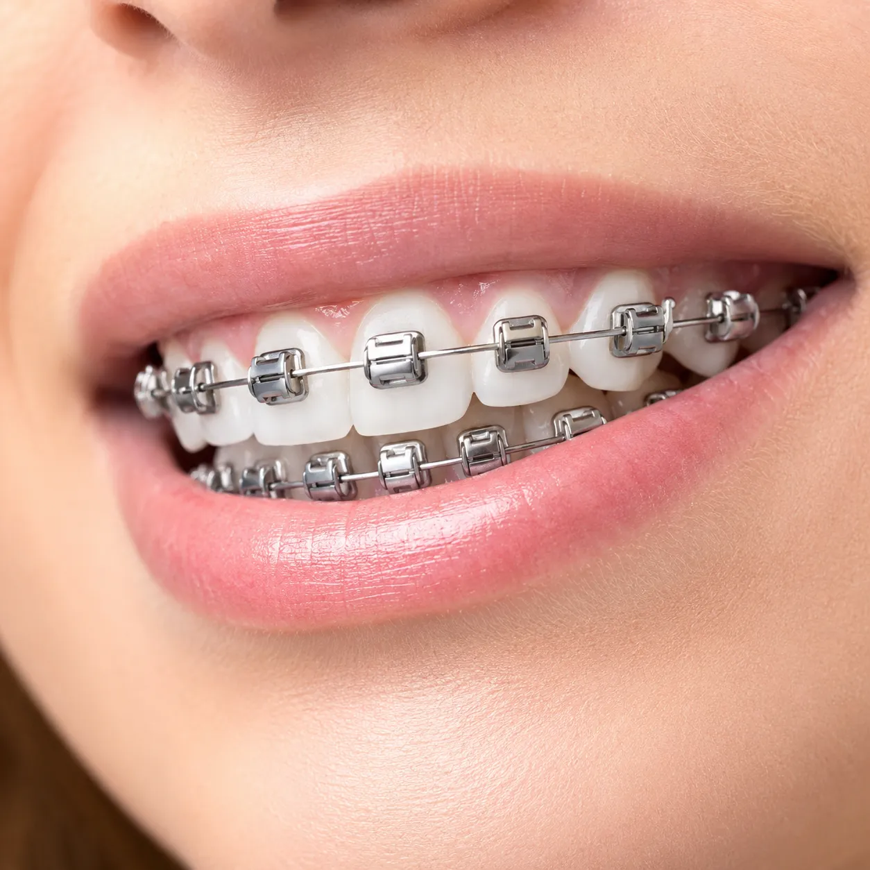 Smile with self-ligating braces - Arasu Dental Care, Coimbatore
