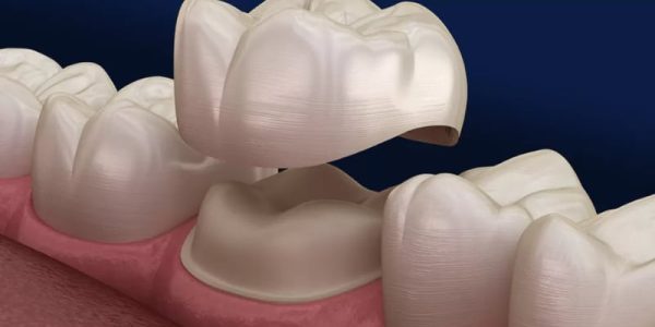 5 Benefits of a Dental Crown