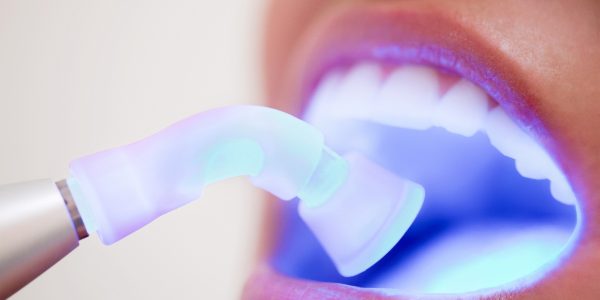 Advantages of Glass Ionomer Filling