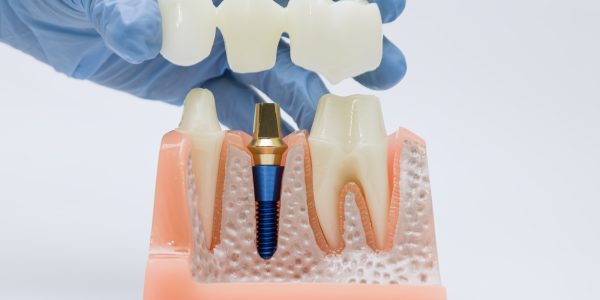 Advantages of Zirconia Crowns and Their Cost