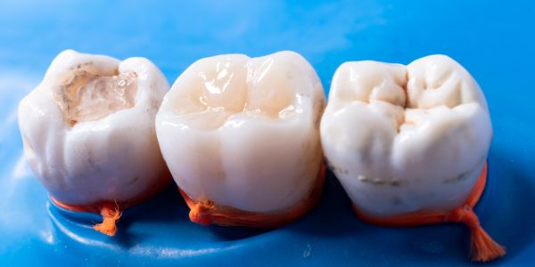 Composite filling