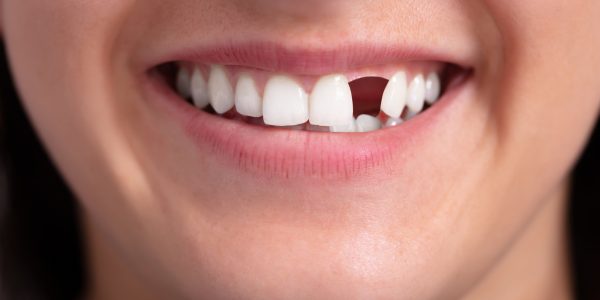 Dental Bridge for Missing Teeth