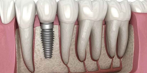 Dental Implants Surgery in Coimbatore