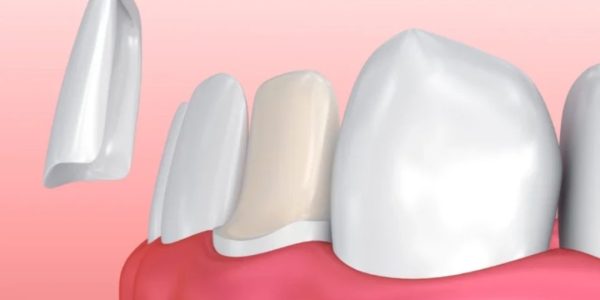 Dental Veneers in Coimbatore