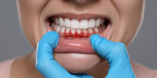 Gum Contouring for a Perfect and Healthy Smile