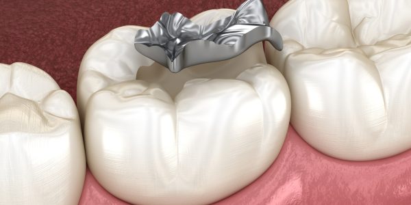 How Is Silver Filling Done