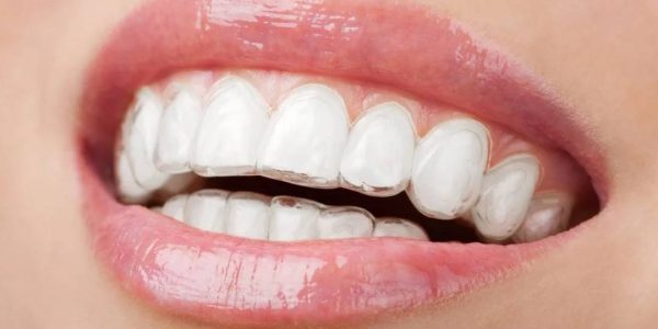 Invisalign Teeth Braces Cost in Coimbatore