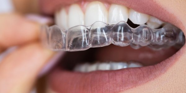 Invisible Retainers
