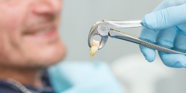 Non Surgical Tooth Extraction