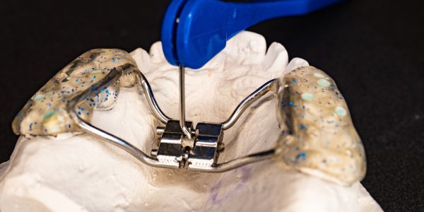 Palatal expanders