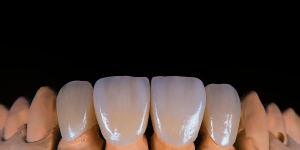 Permanent Ceramic Crown Procedure Explained