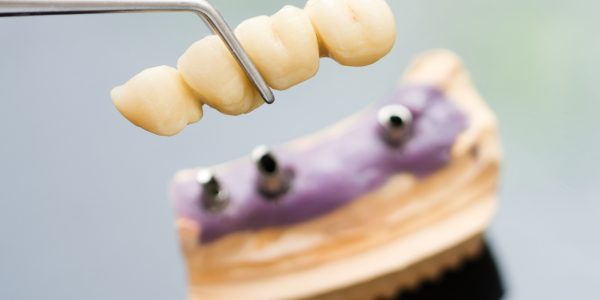 Removable Dental Bridge Treatment
