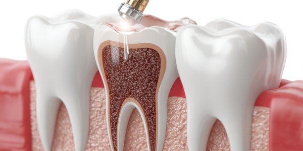 Root canal retreatment