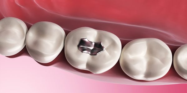 Silver Filling in Dentistry