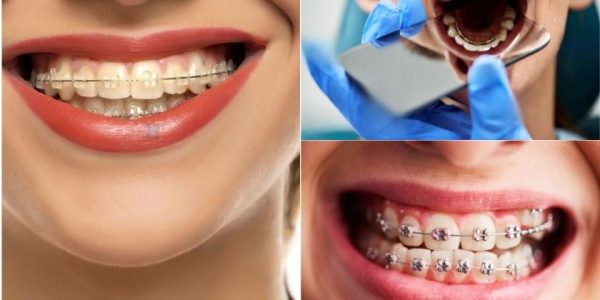 TYpes-of-braces-1