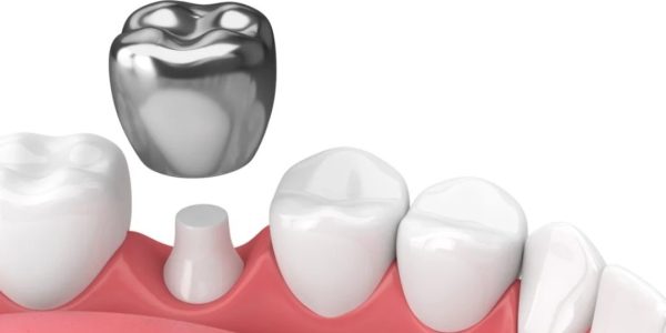 Tooth Cap Cost in Coimbatore