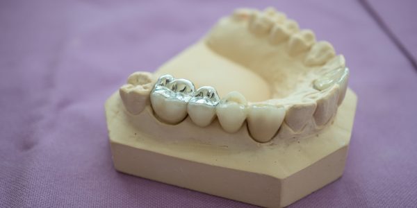 Understanding Amalgam Filling