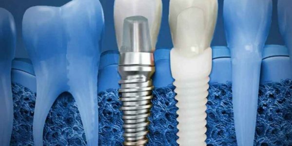 Understanding Dental Implants A Comprehensive Guide