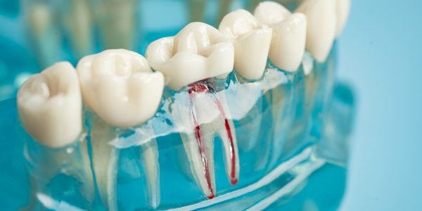 Understanding Root Canal Re Treatment