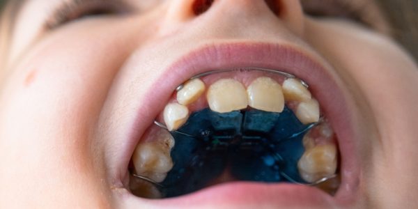 What Happens During a Palatal Expander Treatment