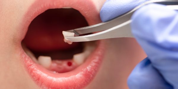 What Happens During a Simple Tooth Extraction
