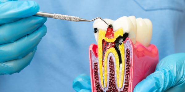 What Is Root End Surgery