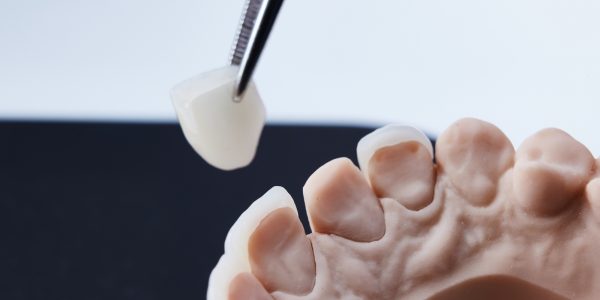 What Is a Ceramic Dental Crown
