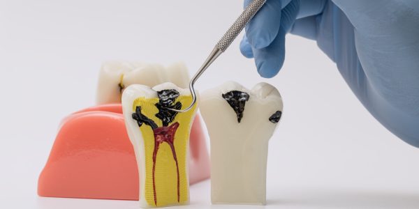 What is a Pulpotomy