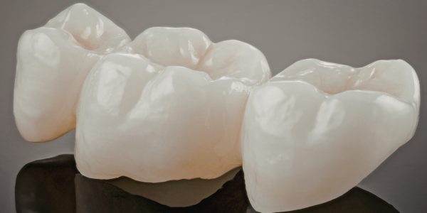 White Filling in Dentistry