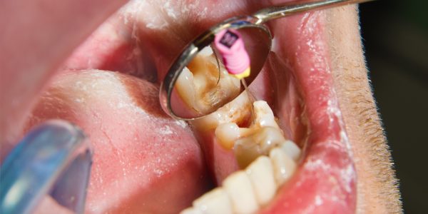 Who Needs a Tooth-Colored Composite Filling
