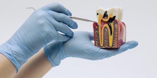 Why Root Canal Re-Treatment Is Necessary