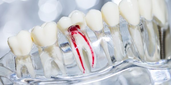 root canal